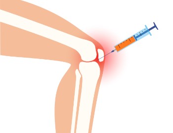 Tratamiento PRP rodilla